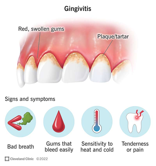Bleeding Gums? Canada’s Top Gum Disease Treatment – Save Your Smile!
