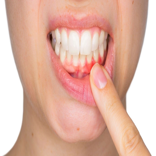 Bleeding Gums? Canada’s Top Gum Disease Treatment – Save Your Smile!